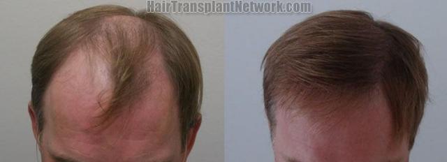 Top view before and after hair restoration procedure