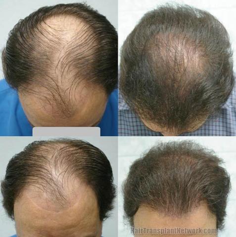 Top view before and after hair restoration photos