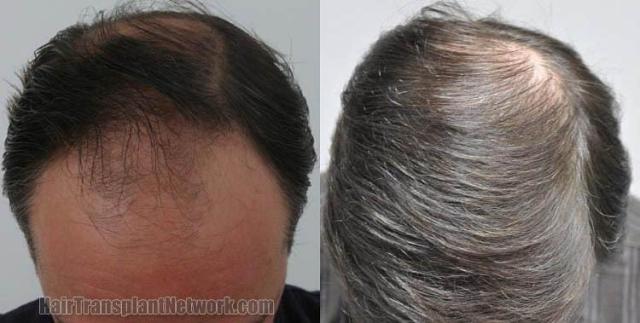 Before and after hair transplant procedure images