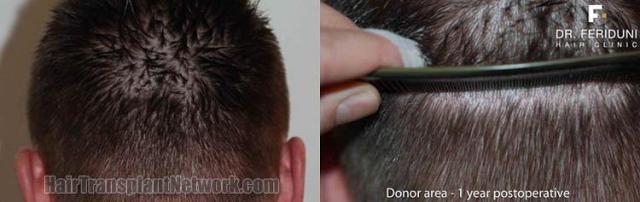 Back view before and after hair transplantation results