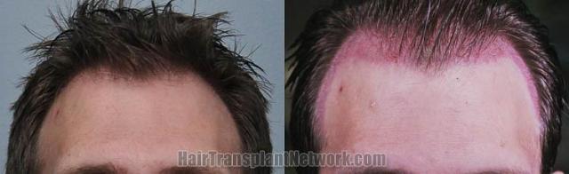 Hair restoration procedure before and after results