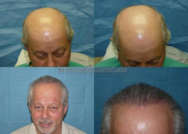 Before and after hair transplantation surgery