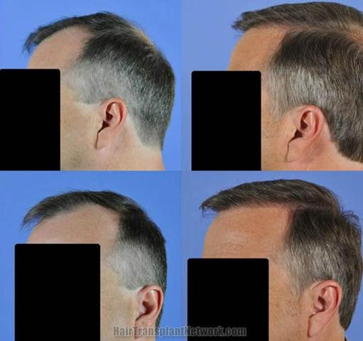Left views before and after hair restoration procedure