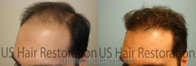 Left view images before and after hair transplantation