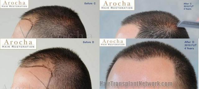 Left view before and after surgical hair restoration repair