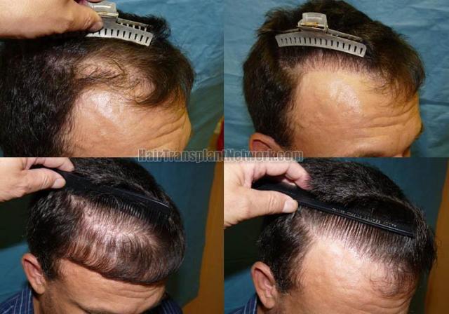 Right view before and after hair restoration images