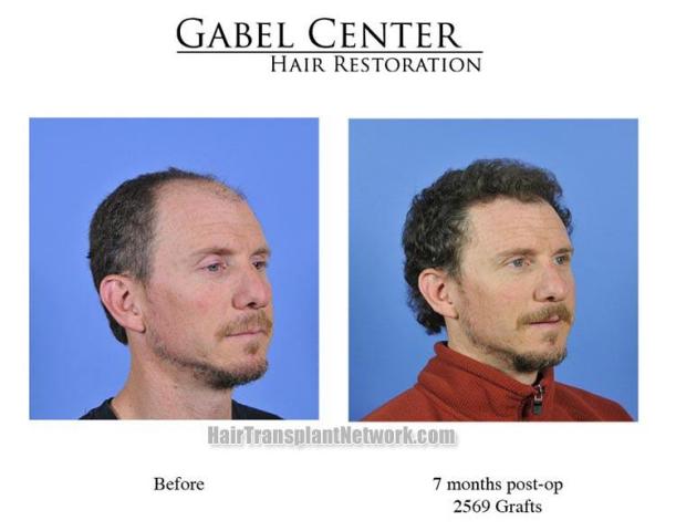 Right oblique view before and after hair transplant