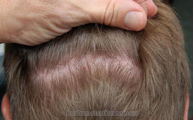 Residual scar one year after hair transplant