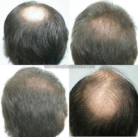 Hair restoration procedure results