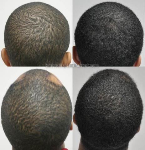 Hair transplantation surgery before and after photos