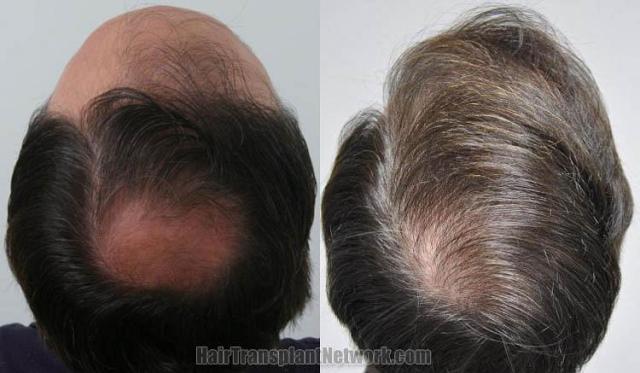 Hair transplantation surgery before and after images