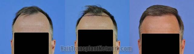 Front view before and after hair replacement procedure