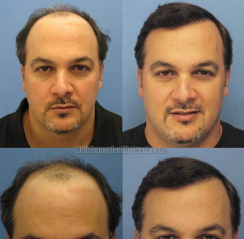 Front photos showing hair transplant surgery results