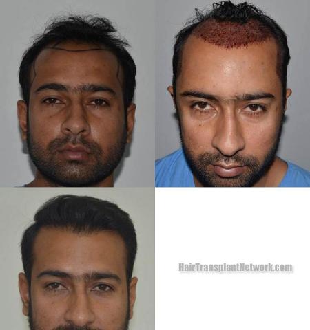 Hair restoration procedure before and after results