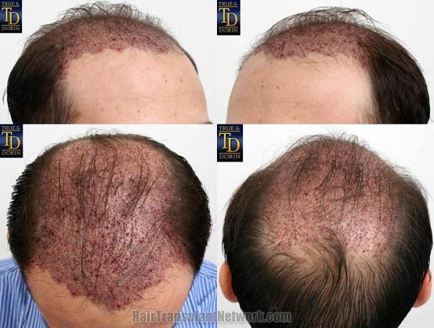 Hair restoration surgery immediate postoperative