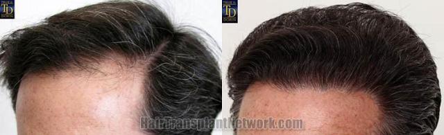 Hair transplantation surgery before and after pictures