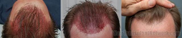 Before and after hair restoration procedure results