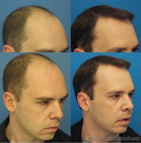 Right views showing before and after photos from hair restoration