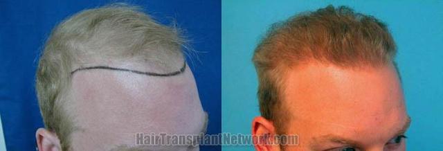 Hair transplantation surgery before and after photos