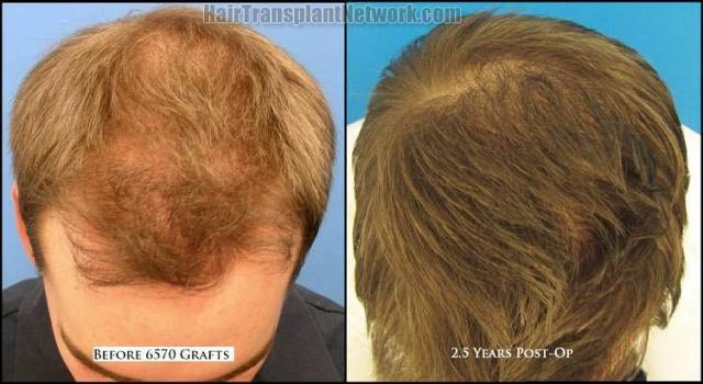 Hair restoration procedure before and after results