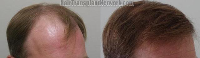 Right view pictures before and after hair transplant procedure