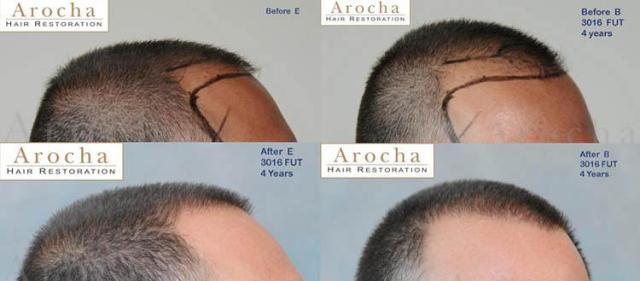 Right view before and after hair transplant repair procedure