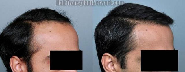 Hair restoration procedure before and after results