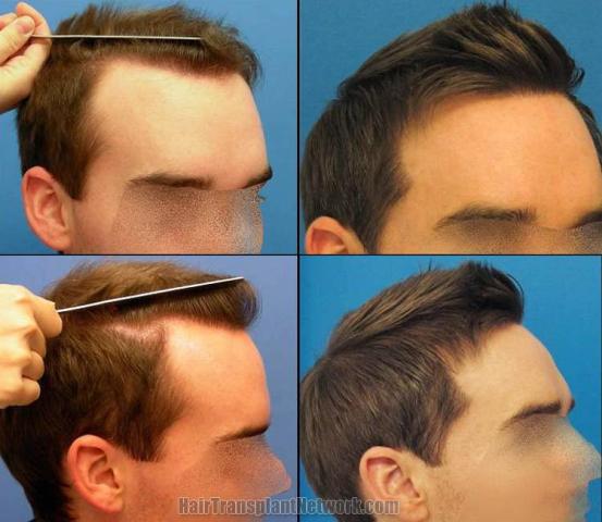 Hair transplantation surgery before and after photos