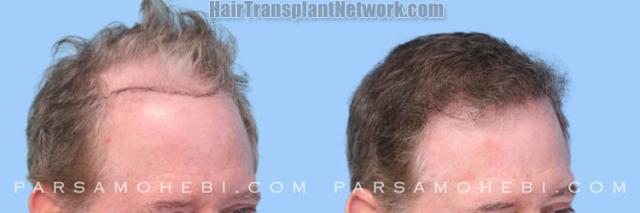 Hair restoration procedure after result images