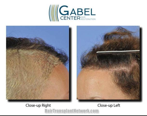 Hair restoration surgery after photos