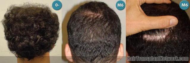 Residual scar before and after hair transplant
