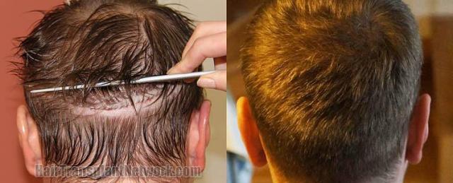 Hair transplantation surgery before and after pictures