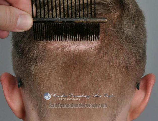 Hair restoration procedure before and after images