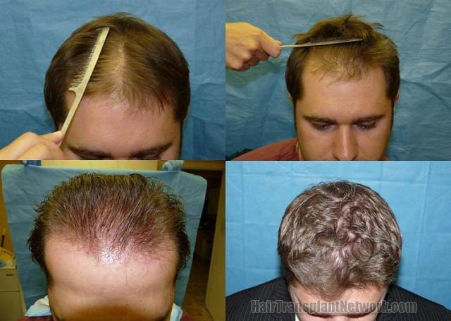 Hair restoration before and after photos