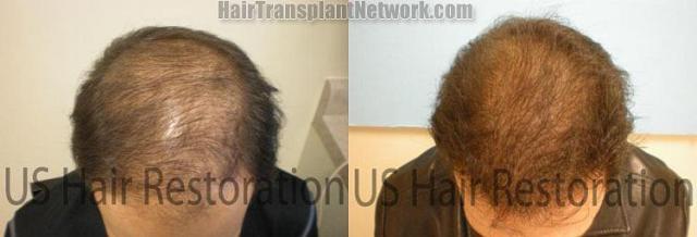 Hair restoration before and after photographs