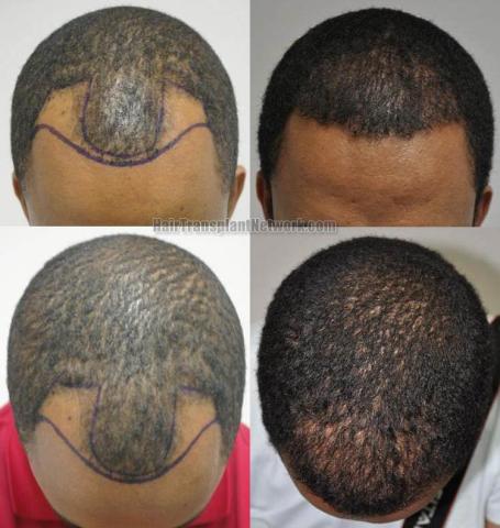 Top view before and after hair restoration results