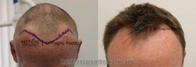 Hair restoration procedure before and after results