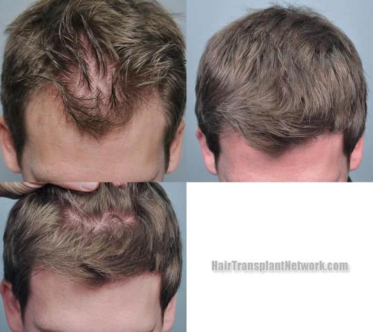 Hair transplantation surgery before and after photos