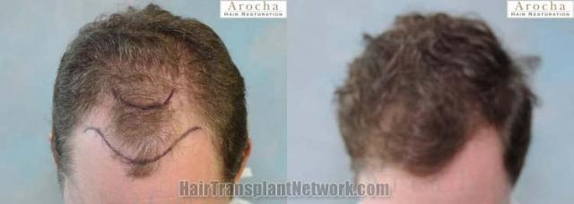 Hair transplantation surgery before and after images