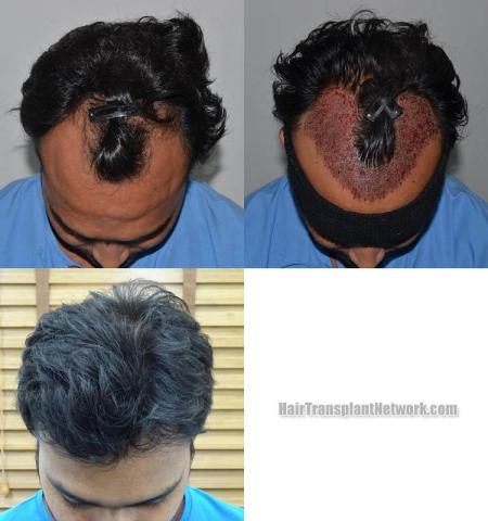 Top view before and after hair restoration results