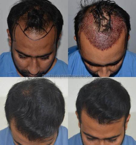 Hair restoration procedure before and after results