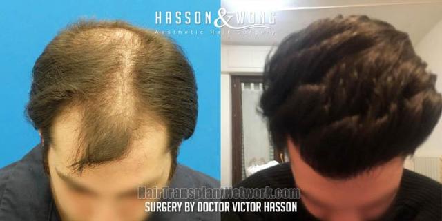 Hair restoration procedure before and after result photos