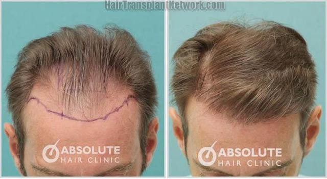 Hair restoration procedure before and after photo results