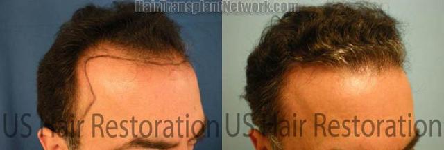 Right view before and after hair replacement surgery photos