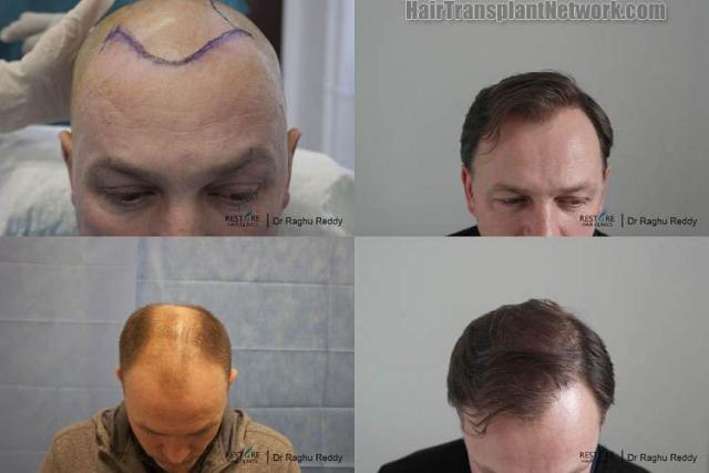 Top view - Before and after surgical hair replacement