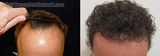Before and after hair transplantation procedure images