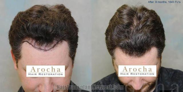 Top view before and after hair restoration results