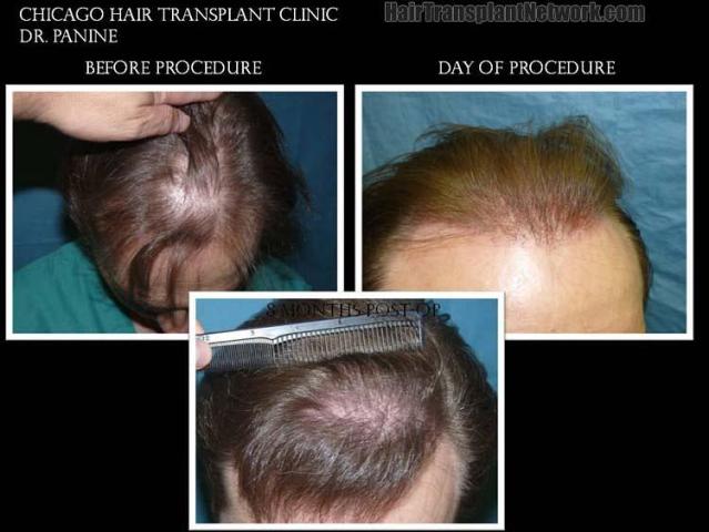 Top view - Before and after surgical hair replacement