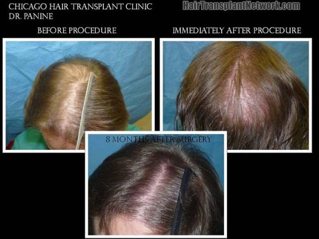 Top view - Before and after surgical hair replacement