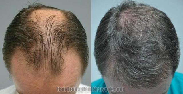 Top view before and after hair restoration results